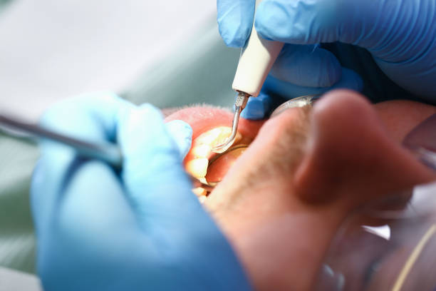 Best Tooth Infection Emergency Dentist  in Ponchatou, LA